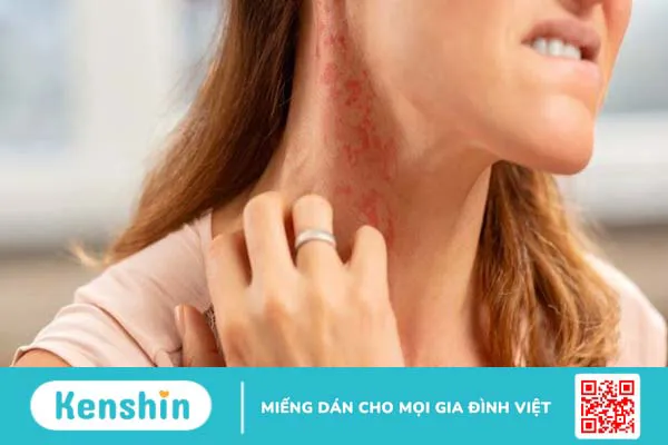 12 cách dùng nha đam (lô hội) trị mụn, đắp mặt hiệu quả tại nhà