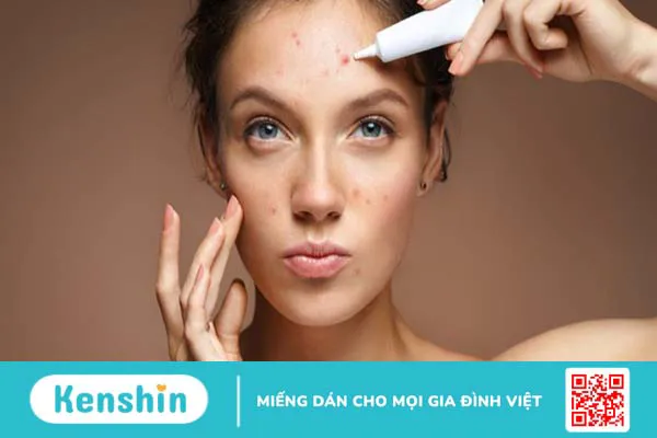 12 cách giảm mụn tại nhà hiệu quả, đơn giản bạn không nên bỏ qua