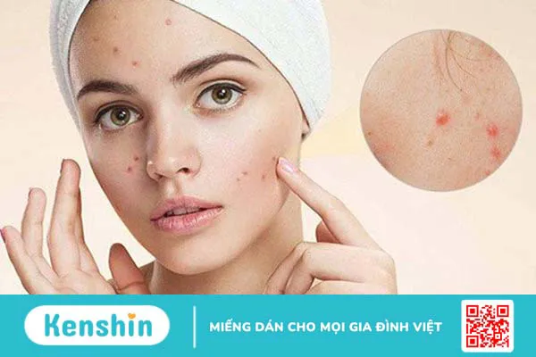 12 cách giảm mụn tại nhà hiệu quả, đơn giản bạn không nên bỏ qua