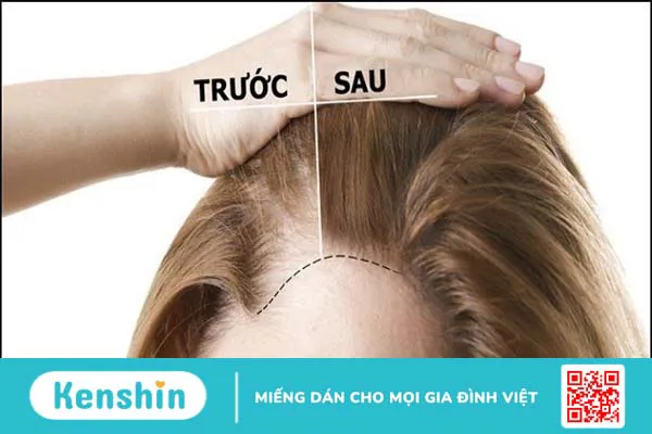 12 Cách gội đầu bằng bia giúp trị gàu, tóc dày, suôn mượt, giảm hư tổn