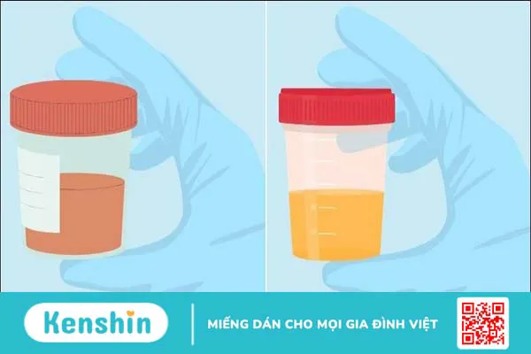 12 dấu hiệu cảnh báo bệnh thận và các thực phẩm nên ăn