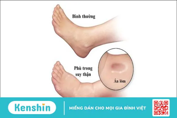 12 dấu hiệu cảnh báo bệnh thận và các thực phẩm nên ăn