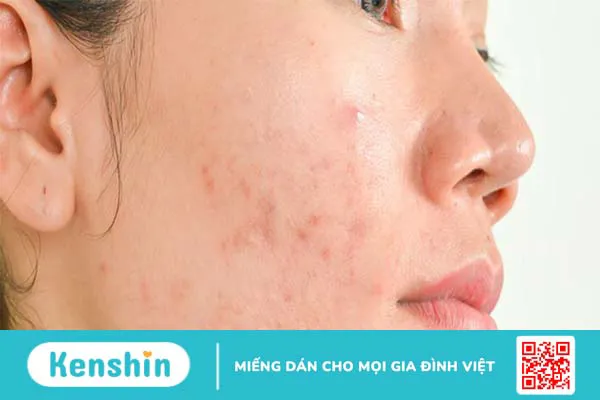 12 tác dụng của nước hoa hồng giúp nàng khỏe đẹp mỗi ngày