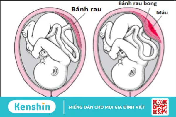 13 biến chứng thai kỳ mẹ bầu cần lưu ý trong thời gian mang thai