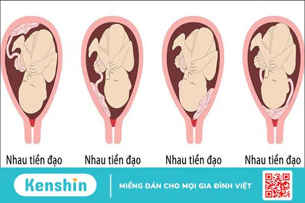 13 biến chứng thai kỳ mẹ bầu cần lưu ý trong thời gian mang thai