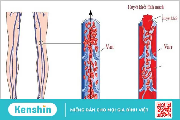 13 biến chứng thai kỳ mẹ bầu cần lưu ý trong thời gian mang thai