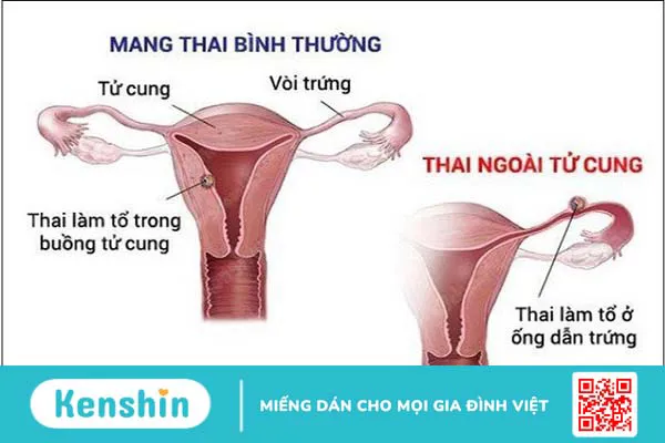 13 biến chứng thai kỳ mẹ bầu cần lưu ý trong thời gian mang thai