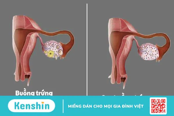 13 nguyên nhân chậm kinh mà không có thai bạn nữ cần lưu ý