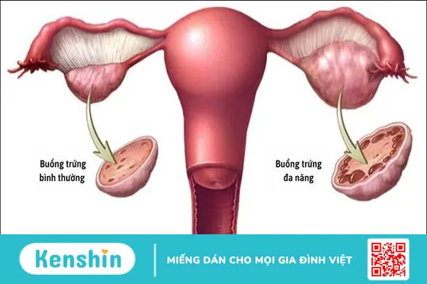 13 nguyên nhân chậm kinh mà không có thai bạn nữ cần lưu ý