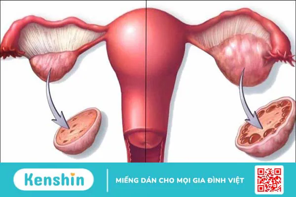 13 nguyên nhân chậm kinh mà không có thai bạn nữ cần lưu ý