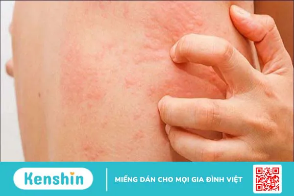 13 nguyên nhân phát ban da và cách khắc phục bạn cần nên biết