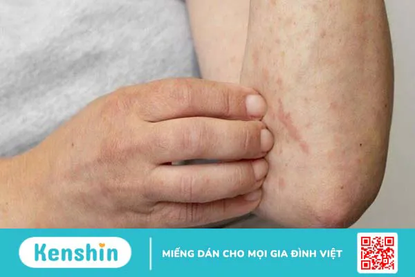 13 tác dụng phụ của thuốc kháng sinh bạn không nên bỏ qua