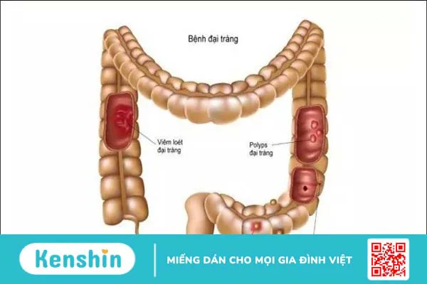 14 cách chữa viêm đại tràng tại nhà đơn giản, hiệu quả và an toàn