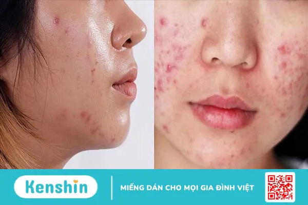 14 cách se khít lỗ chân lông tại nhà đơn giản, hiệu quả cho nàng