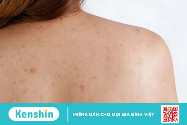 14 cách trị mụn lưng tại nhà tự nhiên, không gây thâm mụn