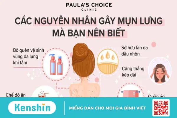 14 cách trị mụn lưng tại nhà tự nhiên, không gây thâm mụn