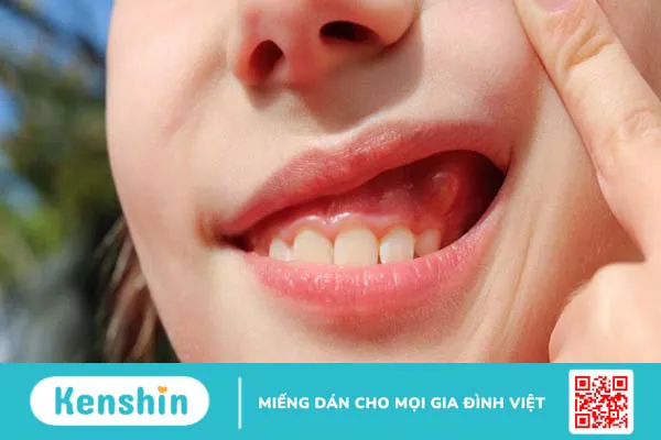 14 cách trị sưng nướu răng tại nhà đơn giản, hiệu quả bạn nên biết