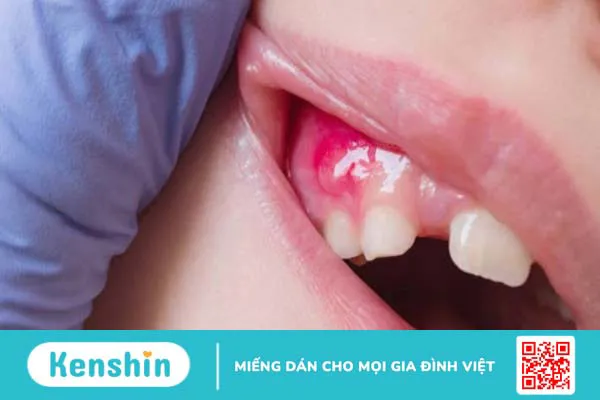 14 cách trị sưng nướu răng tại nhà đơn giản, hiệu quả bạn nên biết