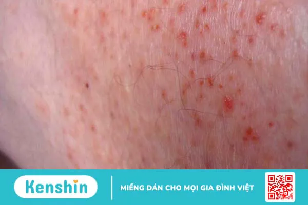 14 tác hại của béo phì đối với cơ thể bạn cần biết