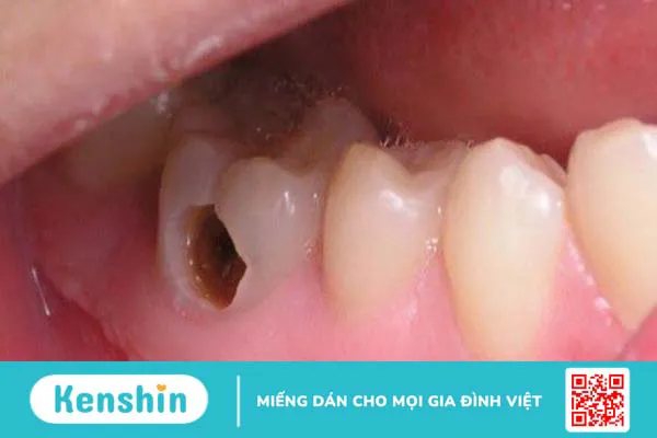 15 bệnh lý răng miệng thường gặp, nguyên nhân và cách điều trị