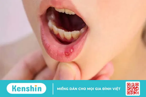 15 bệnh lý răng miệng thường gặp, nguyên nhân và cách điều trị