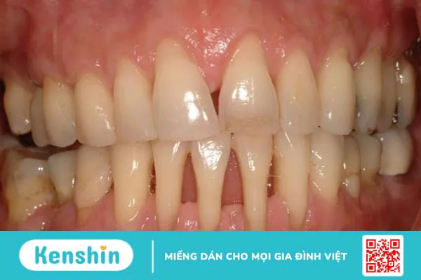 15 bệnh lý răng miệng thường gặp, nguyên nhân và cách điều trị