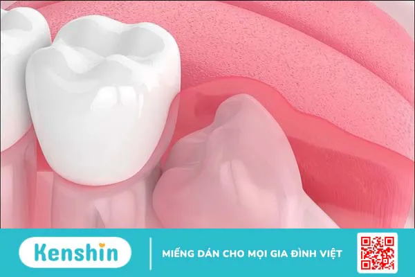 15 bệnh lý răng miệng thường gặp, nguyên nhân và cách điều trị