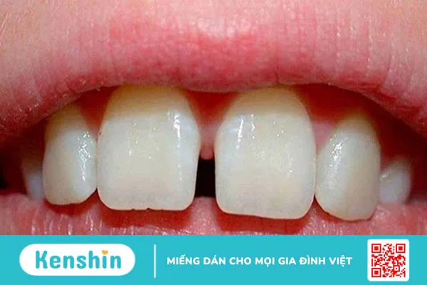 15 bệnh lý răng miệng thường gặp, nguyên nhân và cách điều trị