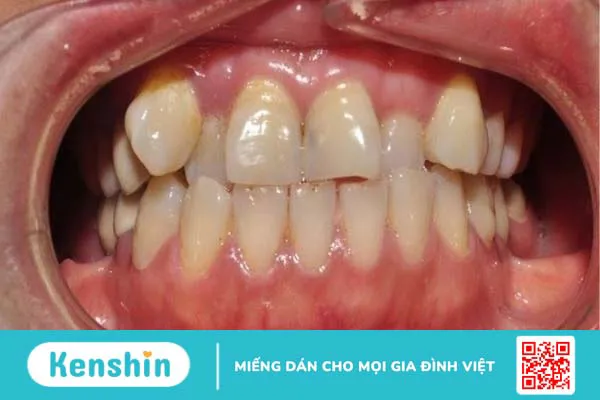 15 bệnh lý răng miệng thường gặp, nguyên nhân và cách điều trị