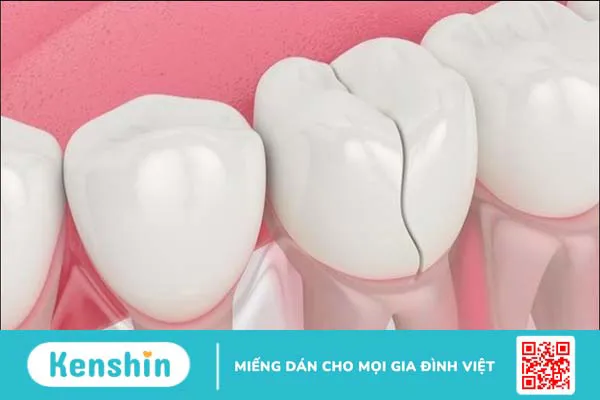 15 bệnh lý răng miệng thường gặp, nguyên nhân và cách điều trị