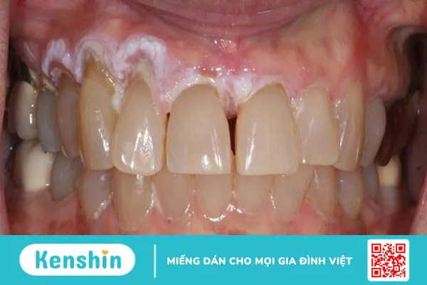 15 bệnh lý răng miệng thường gặp, nguyên nhân và cách điều trị