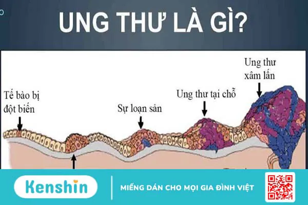 15 nguyên nhân gây ung thư mà bạn có thể nhận biết để phòng ngừa