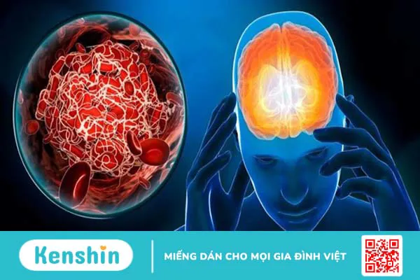 15 nguyên nhân sụp mí mắt và phương pháp khắc phục hiệu quả