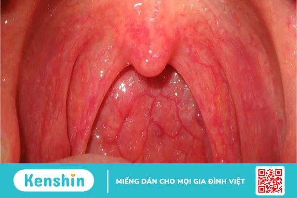 15 nguyên nhân viêm họng phổ biến bạn không thể chủ quan