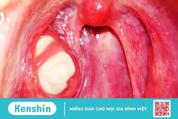 15 nguyên nhân viêm họng phổ biến bạn không thể chủ quan