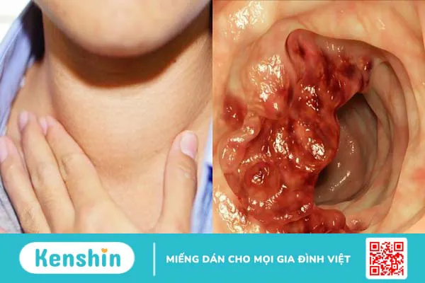 15 nguyên nhân viêm họng phổ biến bạn không thể chủ quan