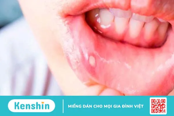 15 tác dụng phụ của hoá trị ung thư, cách chăm sóc bệnh nhân hoá trị