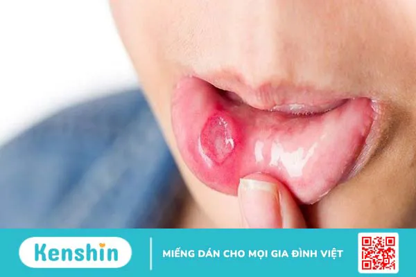 15 tác dụng phụ của xạ trị thường gặp ở bệnh nhân ung thư