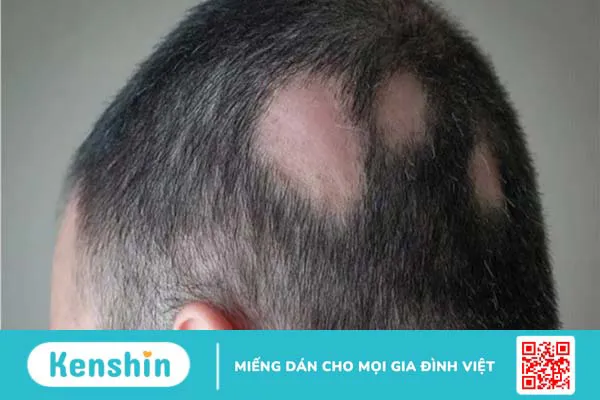 15 tác dụng phụ của xạ trị thường gặp ở bệnh nhân ung thư