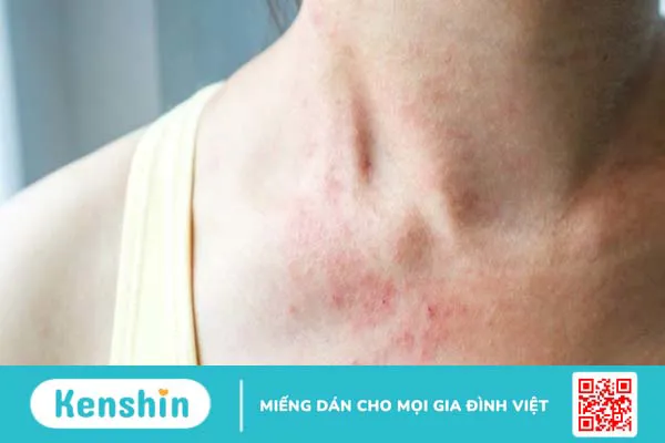 16 cách phòng ngừa và điều trị rôm sảy vào mùa nắng bạn cần biết