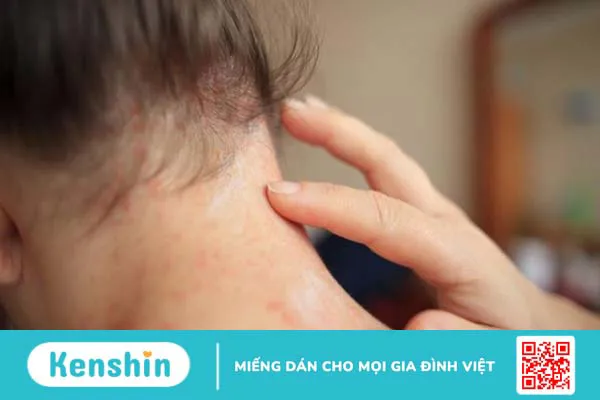 16 cách phòng ngừa và điều trị rôm sảy vào mùa nắng bạn cần biết