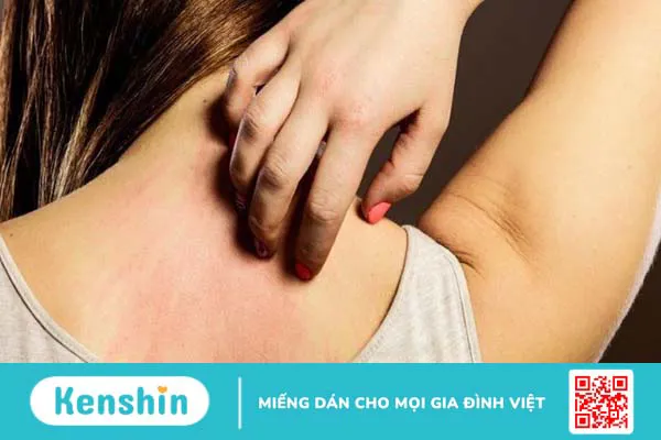 16 cách trị ghẻ ngứa tại nhà đơn giản, hiệu quả, an toàn