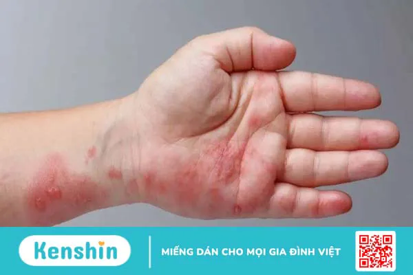 16 cách trị ghẻ ngứa tại nhà đơn giản, hiệu quả, an toàn