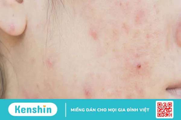 16 công dụng của vaseline trong làm đẹp và lưu ý khi sử dụng