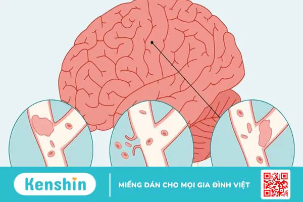 16 di chứng sau đột quỵ thường gặp và các biện pháp phòng ngừa đột quỵ