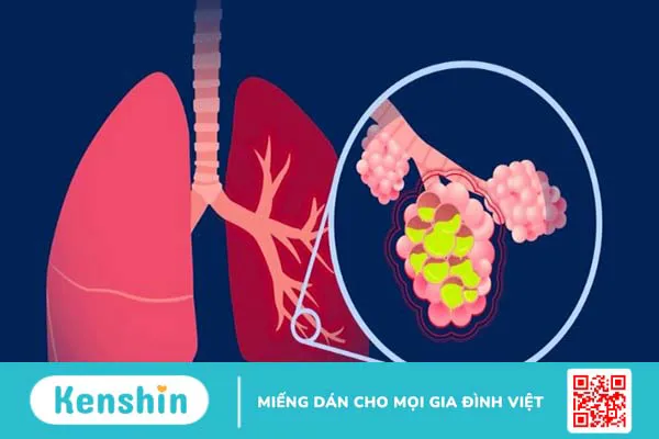 16 di chứng sau đột quỵ thường gặp và các biện pháp phòng ngừa đột quỵ