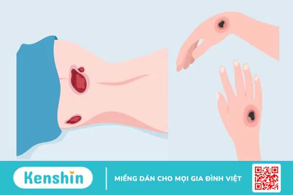 16 di chứng sau đột quỵ thường gặp và các biện pháp phòng ngừa đột quỵ