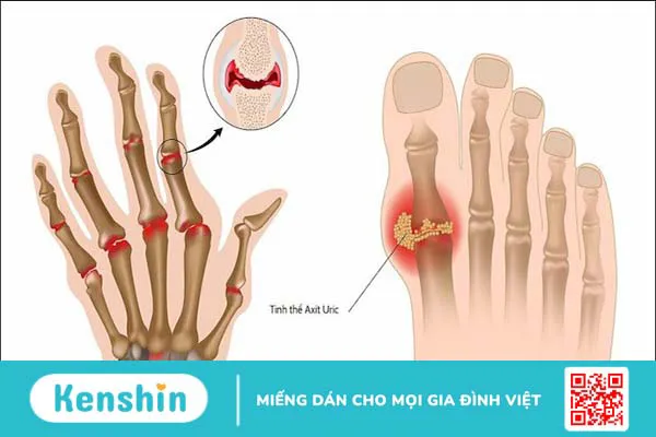 16 tác dụng của cây xuyến chi dành cho sức khỏe bạn nên biết