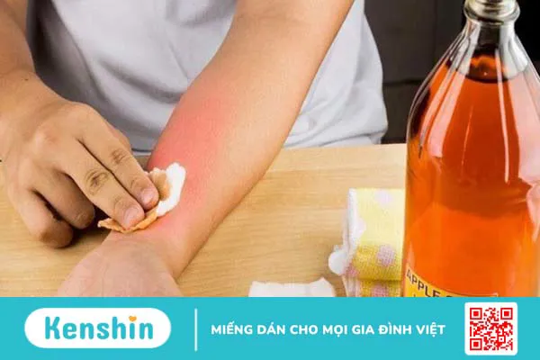 17 cách chữa viêm da cơ địa tại nhà an toàn bạn nên lưu ý ngay!