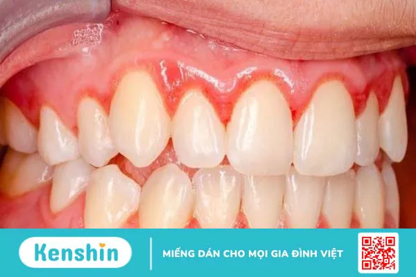 17 cách chữa viêm lợi tại nhà nhanh nhất, an toàn, hiệu quả